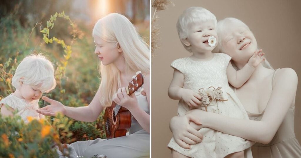 Systrarna föddes med albinism med 12 års mellanrum - se bara hur vackra de är idag